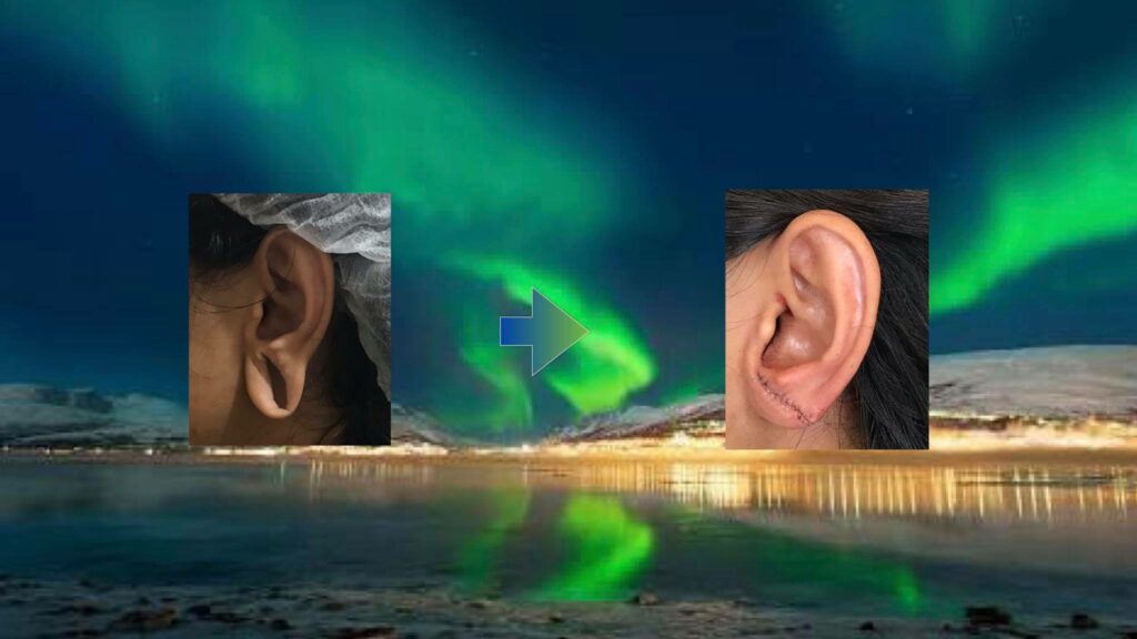 earlobe correction