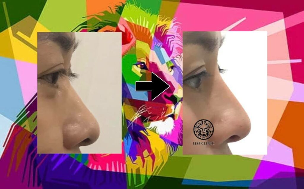 nose augmentation