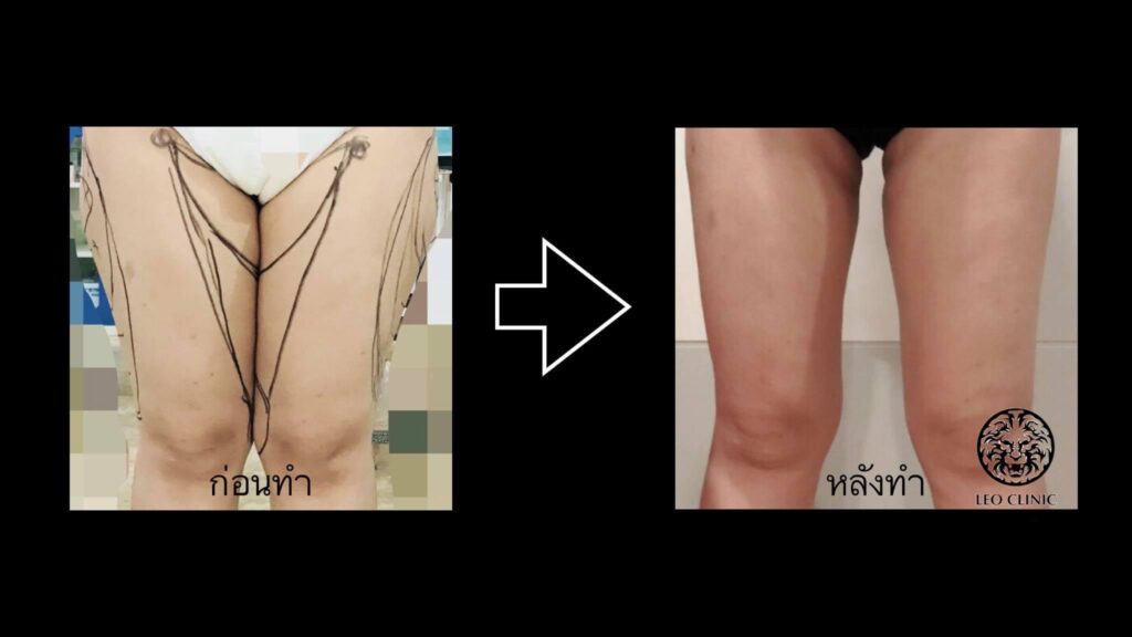 leg liposuction