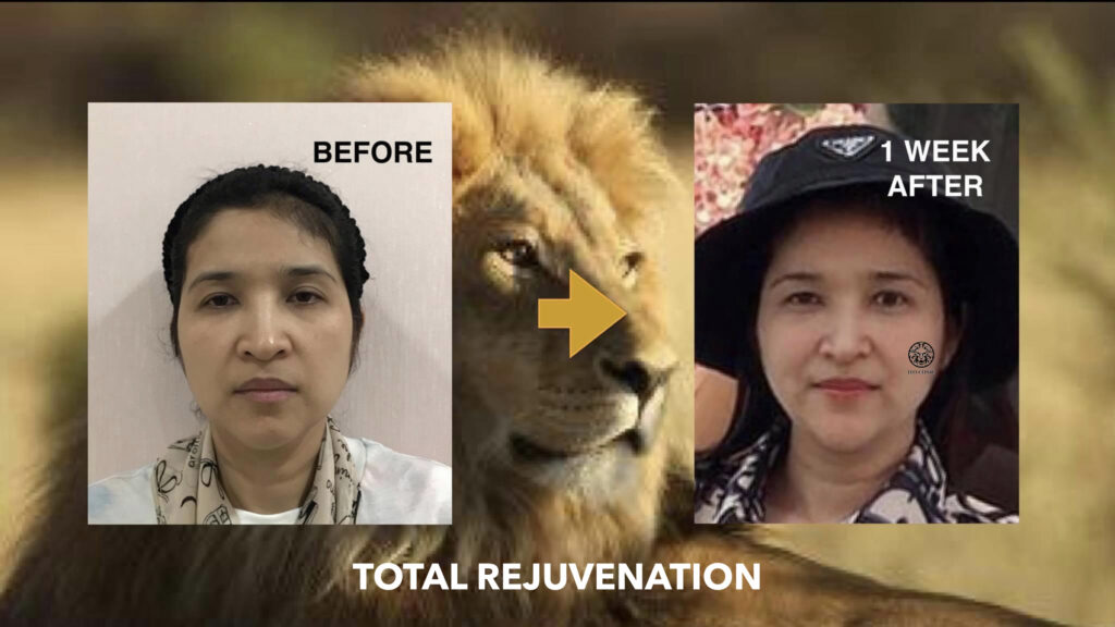 facial rejuvenation