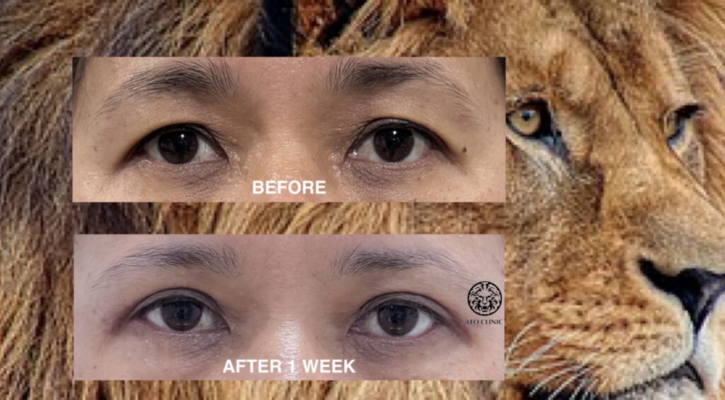 blepharoplasty