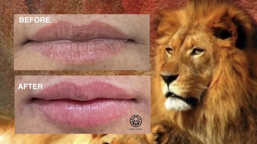 Lip augmentation